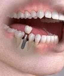 dental implants